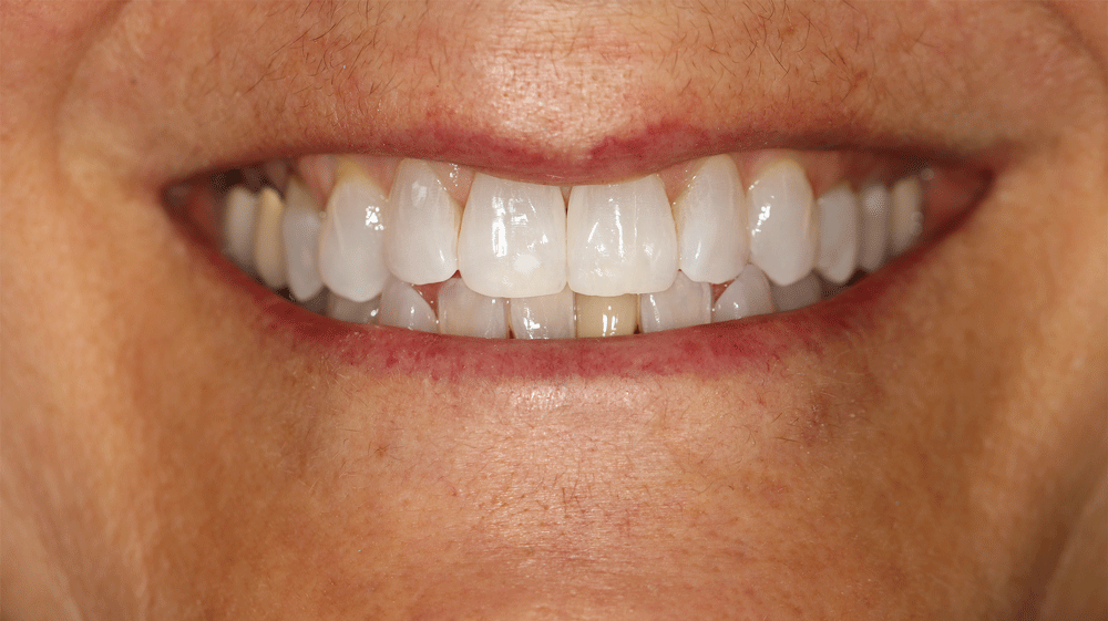 Close-up of a person's mouth with clean, white, well-aligned teeth and healthy pink gums.