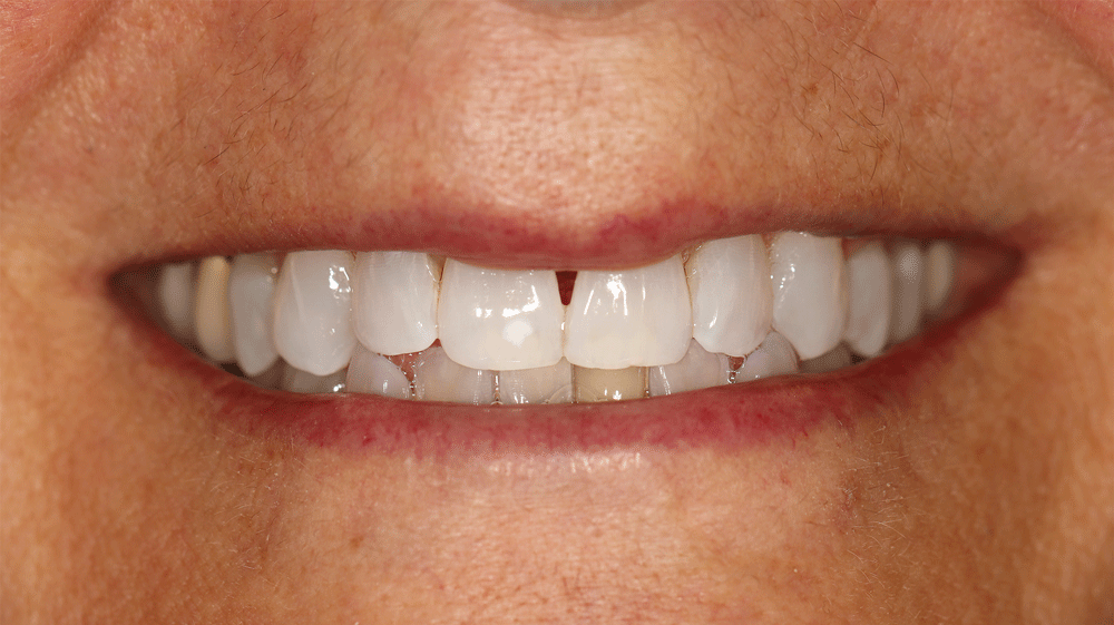The image shows a close-up of a person's mouth, focusing on the teeth. The teeth are well-aligned and clean, with a small gap between the two upper front teeth. The lips are slightly parted, revealing the teeth and gums.