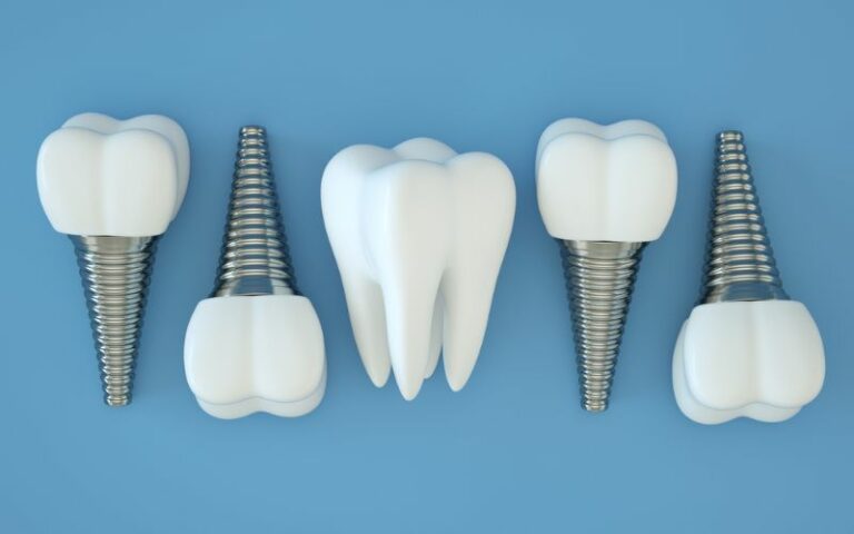 An illustration of dental implants