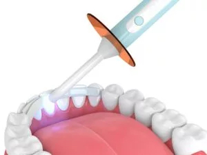 An illustration demonstrates dental bonding