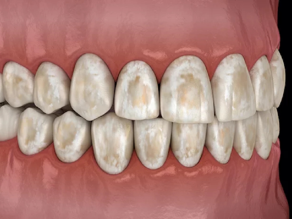 Illustration of stained teeth.