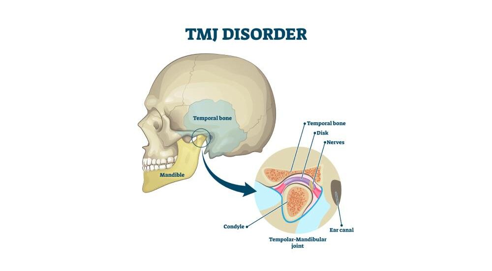 TMJ is shown in an illustration