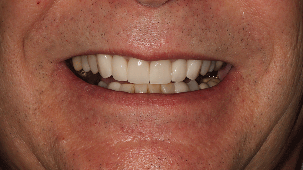 The image shows a close-up of a person's mouth, focusing on the teeth and lips. The teeth appear well-aligned and clean, with the upper teeth being more prominently visible. The gums and lips are also visible, showcasing some natural skin texture and coloration.