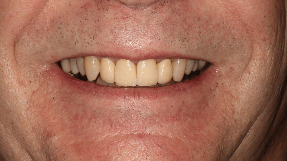 The image shows a close-up of a person's mouth, focusing on the teeth. The teeth appear to be in good condition, with the front teeth being slightly yellowed compared to the others. The gums and surrounding skin are visible, showing natural skin texture and some small blemishes.