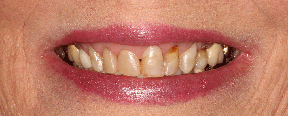 The image shows a close-up of a person's mouth with lips covered in pink lipstick. The teeth are visible and appear to be in poor condition, with noticeable discoloration, wear, and possible decay. Some teeth have dark stains, and the gums are slightly visible.
