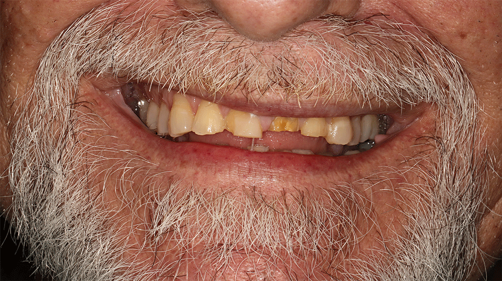 The image shows a close-up of an older individual's mouth with a white mustache and beard. The teeth are slightly discolored, with some yellowing and staining, particularly on the upper front teeth. The skin around the mouth shows signs of aging.