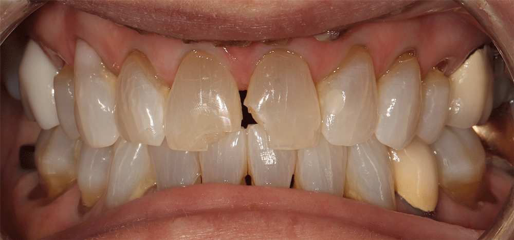 The image shows a close-up view of a person's teeth. The teeth exhibit visible discoloration and staining, particularly on the lower teeth and the edges of the upper teeth. There is noticeable wear and chipping on the front upper teeth, with one tooth having a significant chip.