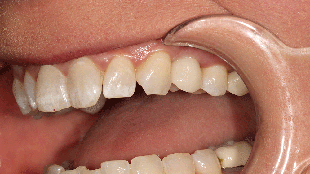 The image shows a close-up view of a person's mouth with a dental retractor in place, exposing the upper and lower teeth. The upper teeth appear to have some discoloration and minor chipping, particularly on the front teeth. The lower teeth are also visible, showing a relatively healthy appearance.