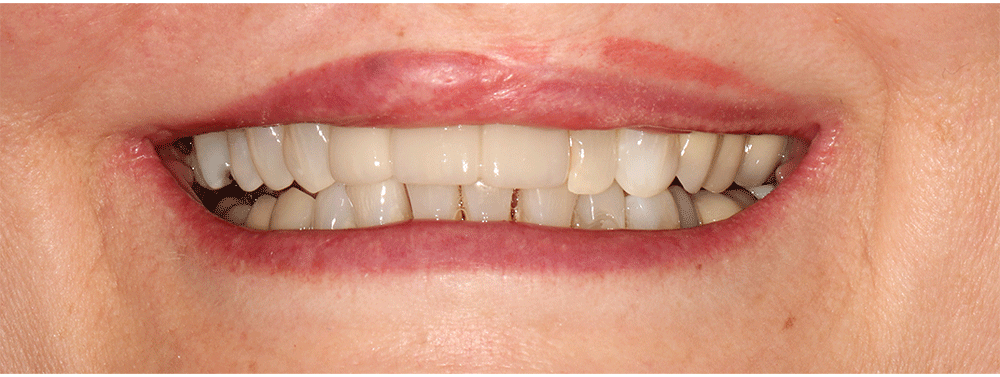 The image shows a close-up of a person's mouth with a focus on the teeth. The teeth are well-aligned and clean, suggesting good dental health or possibly dental work.