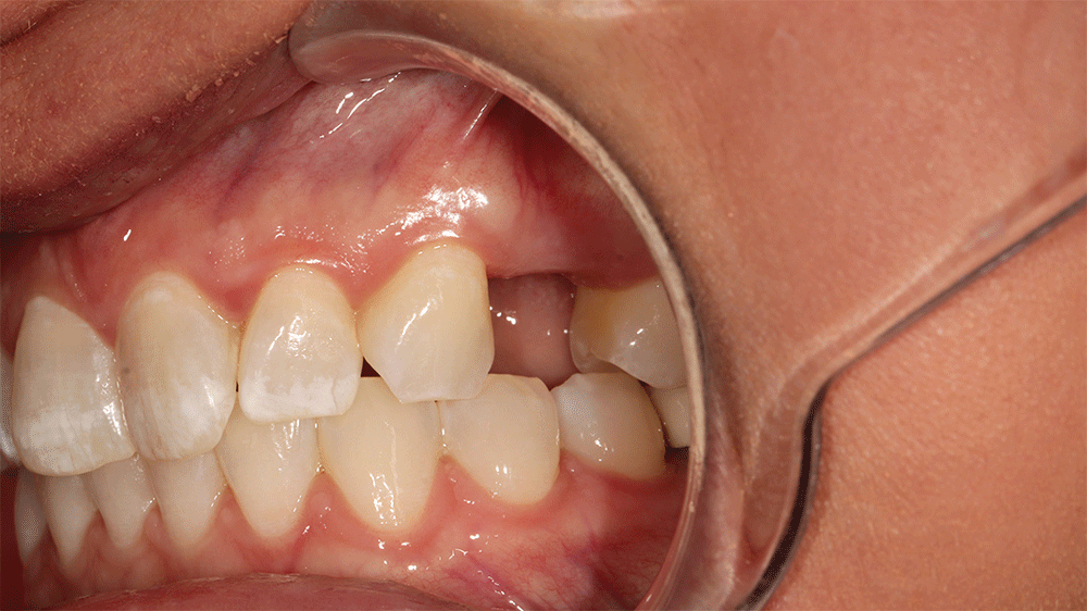 This image shows a close-up view of a person's mouth with a focus on the teeth and gums. The upper and lower teeth are visible, with a noticeable gap where a tooth is missing on the upper row. The gums appear healthy, and a dental retractor is being used to keep the mouth open for examination or treatment.