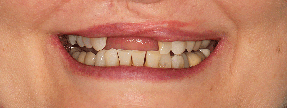 The image shows a close-up of a person's mouth, focusing on the teeth. The teeth appear to be in poor condition, with noticeable gaps, discoloration, and misalignment. The upper front teeth have a significant gap, and the lower teeth show signs of wear and discoloration. The lips are slightly parted, revealing the dental issues clearly.