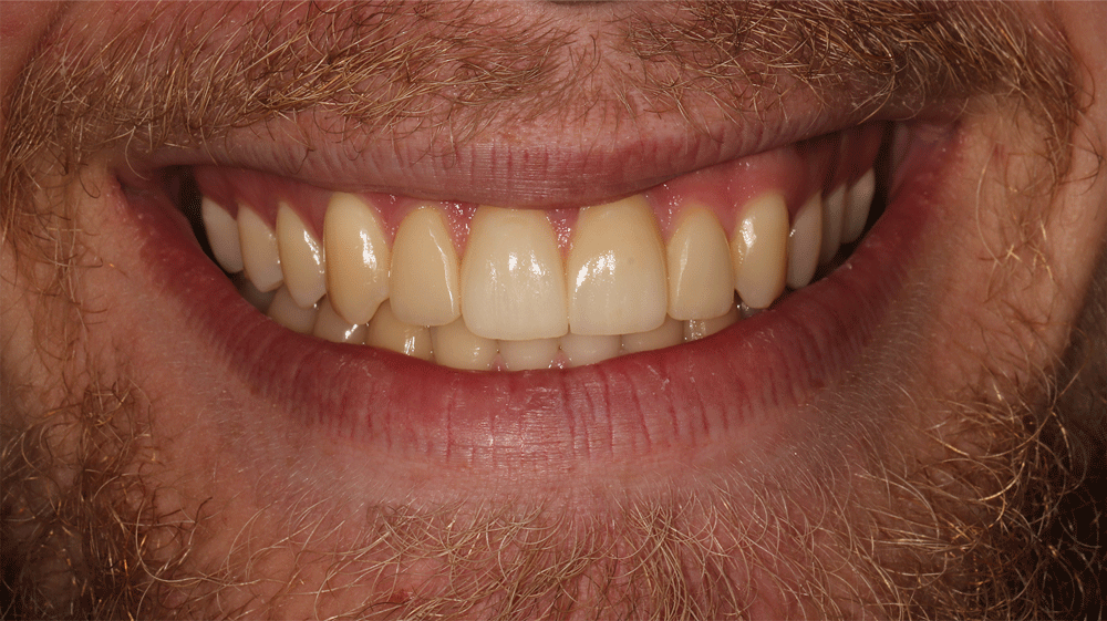 The image shows a close-up of a person's mouth with visible teeth and lips. The teeth appear well-aligned and healthy, and the lips have a natural, unadorned look.