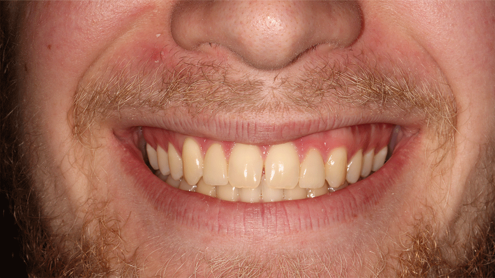 The image shows a close-up of a person's mouth, focusing on the teeth and part of the upper lip. The person is smiling, revealing a full set of healthy-looking teeth. The gums and facial hair, including a mustache and beard, are also visible.